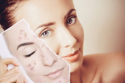 Laser Hair Removal and Acne