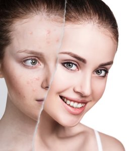 Does Sunscreen Help Acne?